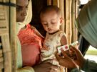 Aid Cuts Drive Rising Child Malnutrition in Rohingya Camps